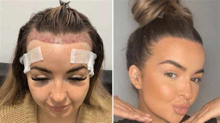 Dan Soder Plastic Surgery: Soder's Decision to Undergo Hair Transplant for Regrowth!